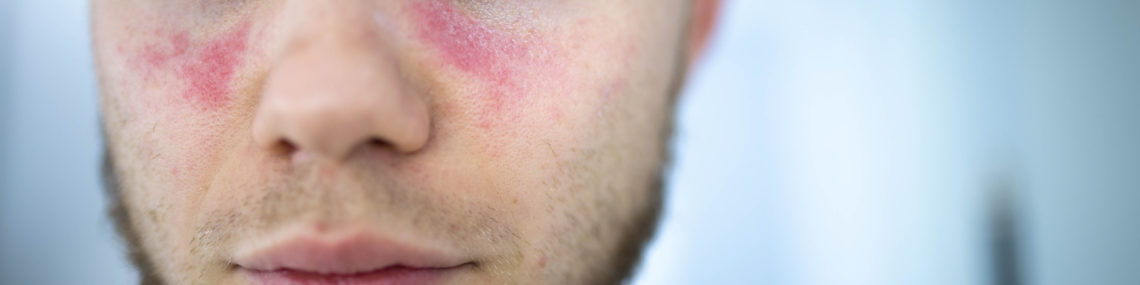 Close-up of a young man’s face showing a butterfly-shaped malar rash across his cheeks and nose, a visible symptom of systemic lupus erythematosus (SLE).