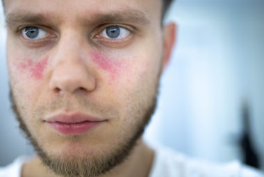 Close-up of a young man’s face showing a butterfly-shaped malar rash across his cheeks and nose, a visible symptom of systemic lupus erythematosus (SLE).