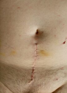 Recent suprapubic prostatectomy scar with bruising between the pubis and umbilicus, illustrating post-surgical scarring that may require scar therapy for improved healing and tissue function.